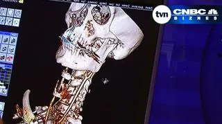 25.05 | Przez ostatnie lata pracowałeś w dobrej firmie, która fundowała ci opiekę medyczną? To już możesz się denerwować... Jeśli okaże się, że twój pracodawca jej kosztów nie wliczał do twoich dochodów - to masz problem. Pracodawca zresztą ma jeszcze większy. (TVN CNBC Biznes)