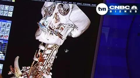 25.05 | Przez ostatnie lata pracowałeś w dobrej firmie, która fundowała ci opiekę medyczną? To już możesz się denerwować... Jeśli okaże się, że twój pracodawca jej kosztów nie wliczał do twoich dochodów - to masz problem. Pracodawca zresztą ma jeszcze większy. (TVN CNBC Biznes)