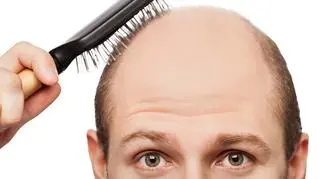 Nadzieja dla łysych: włosy z drukarki 3D