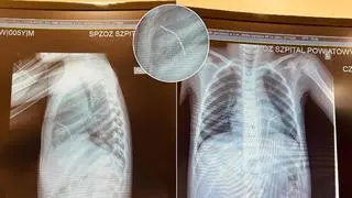 Drut wbił się w lewą komorę serca chłopca