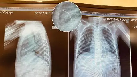 Drut wbił się w lewą komorę serca chłopca