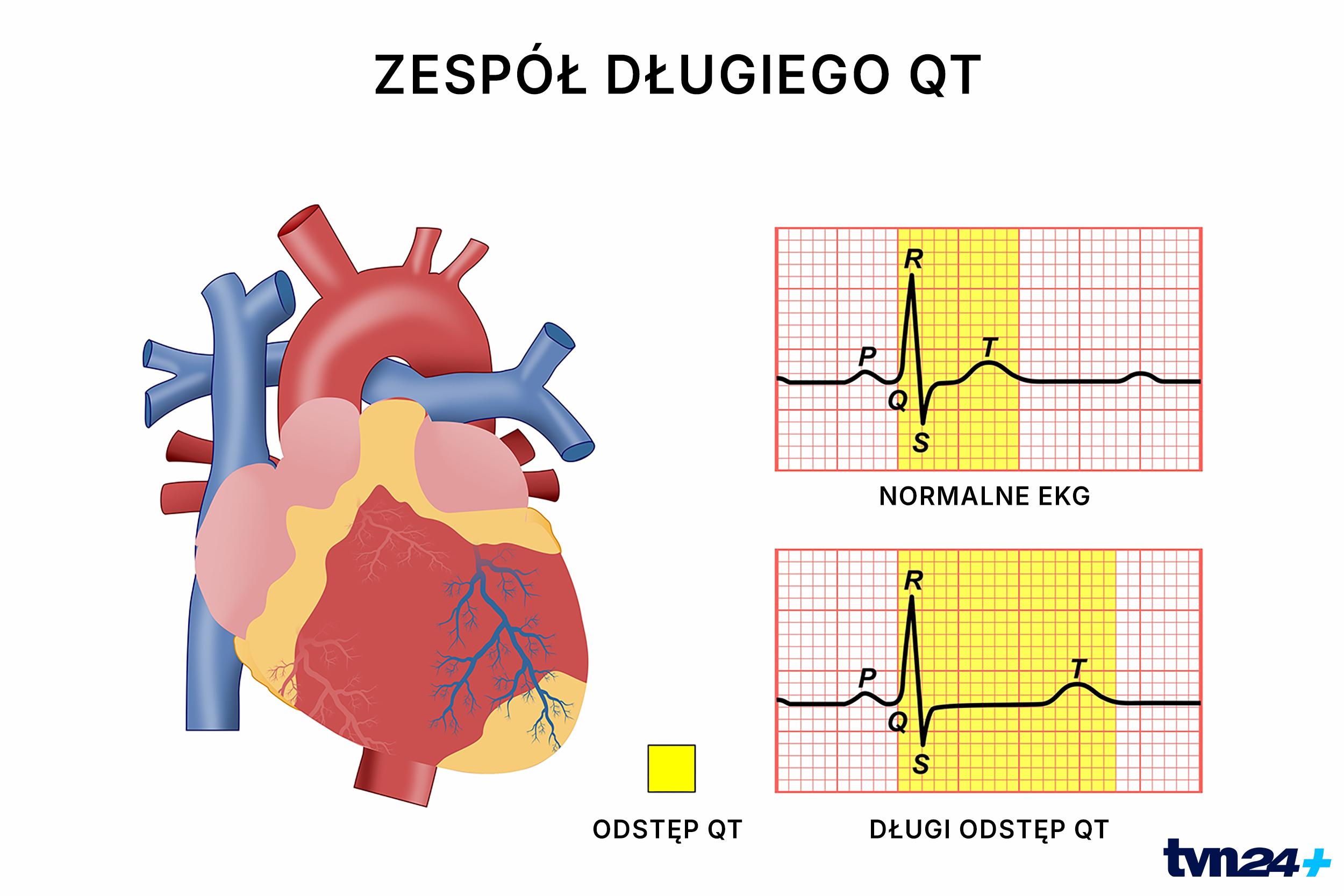 Przyczyną zgonów młodych sportowców bywa zespół długiego QT