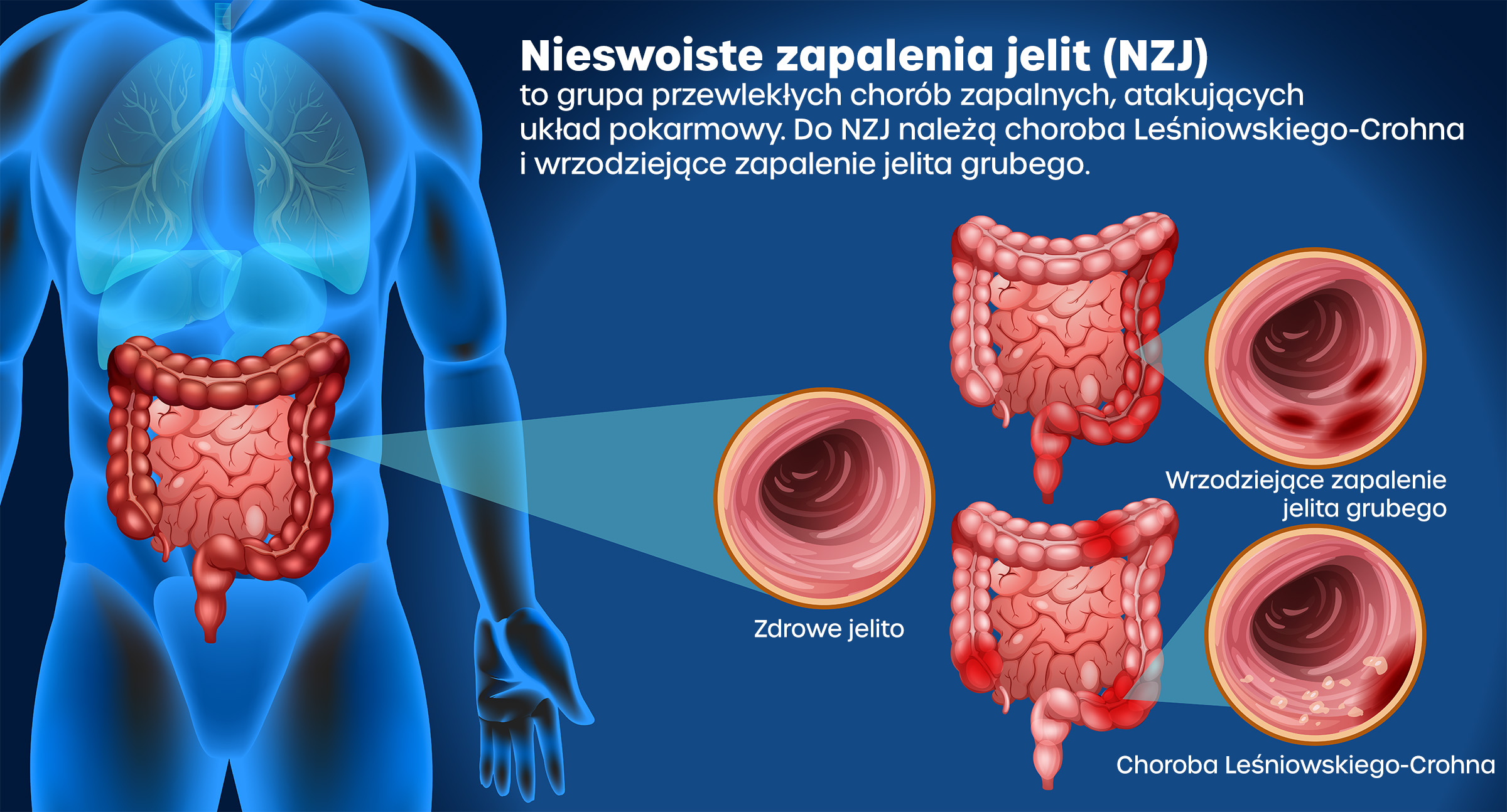 Nieswoiste zapalenia jelit (NZJ)