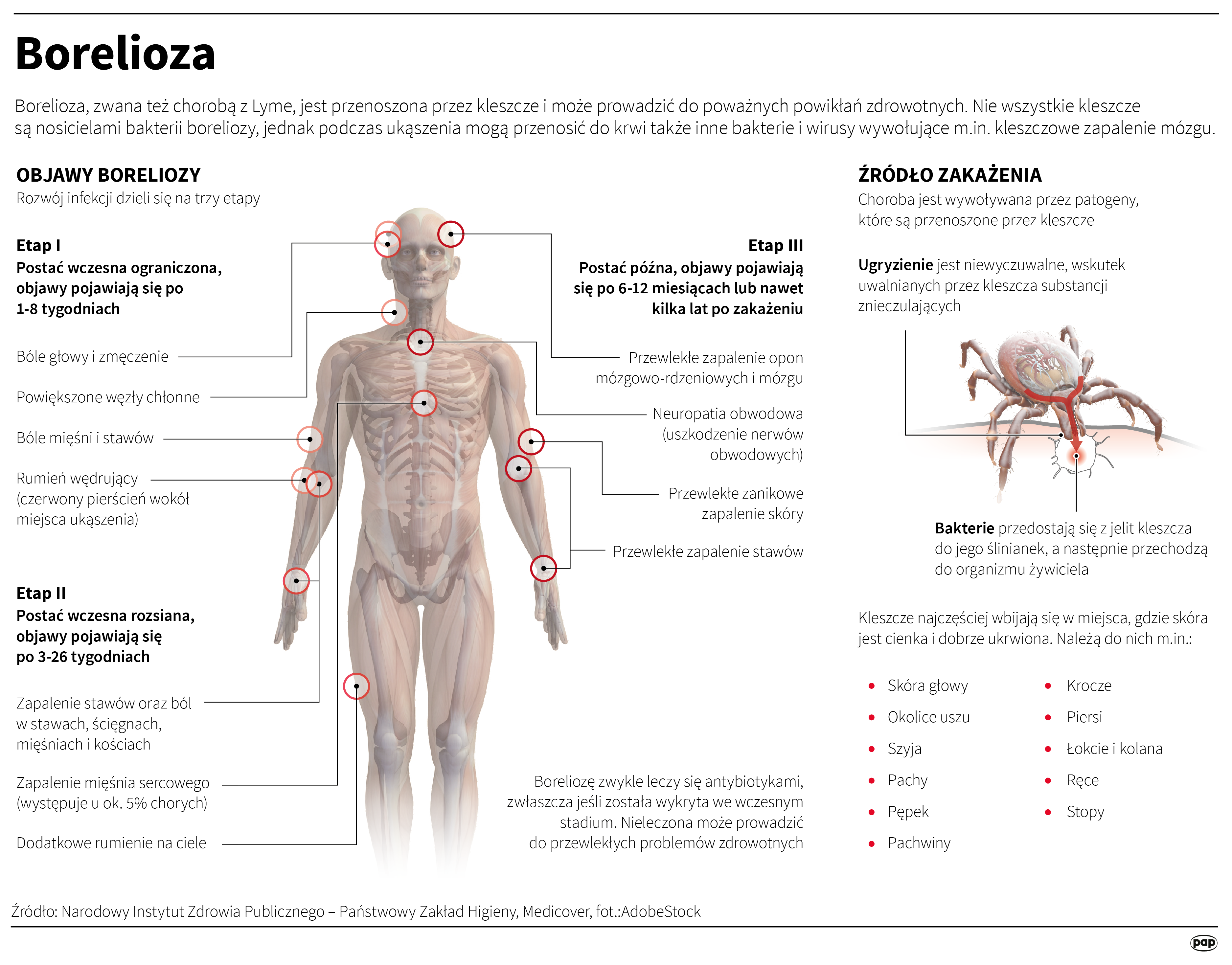 Borelioza to choroba przenoszona przez kleszcze