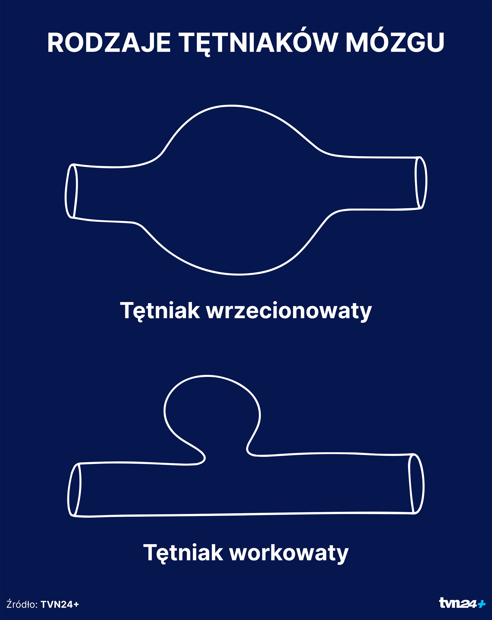 Tętniaki workowate mózgu są częstsze niż wrzecionowate