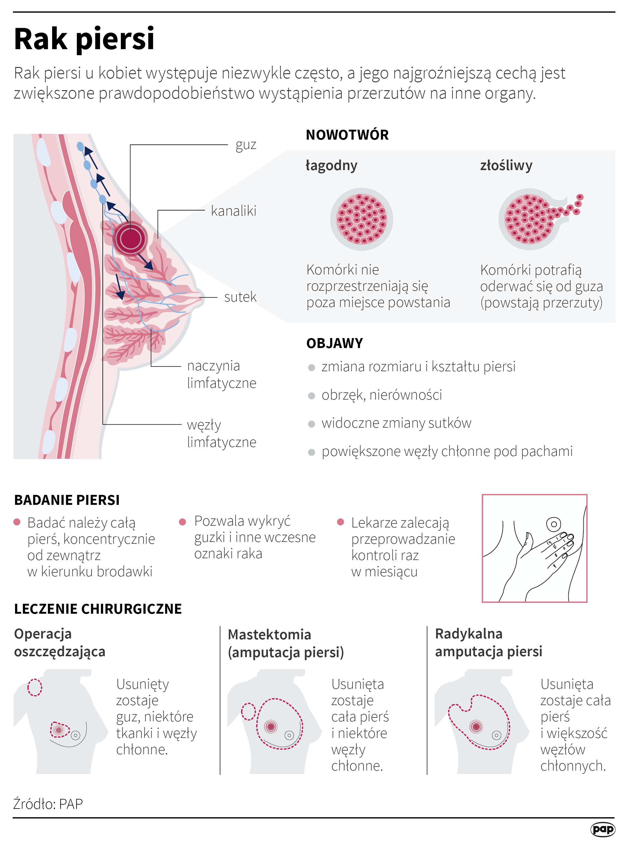 Rak piersi jest częstym nowotworem