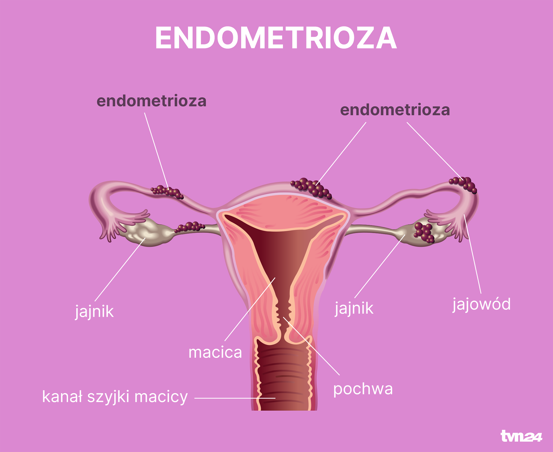 Jak wygląda endometrioza?