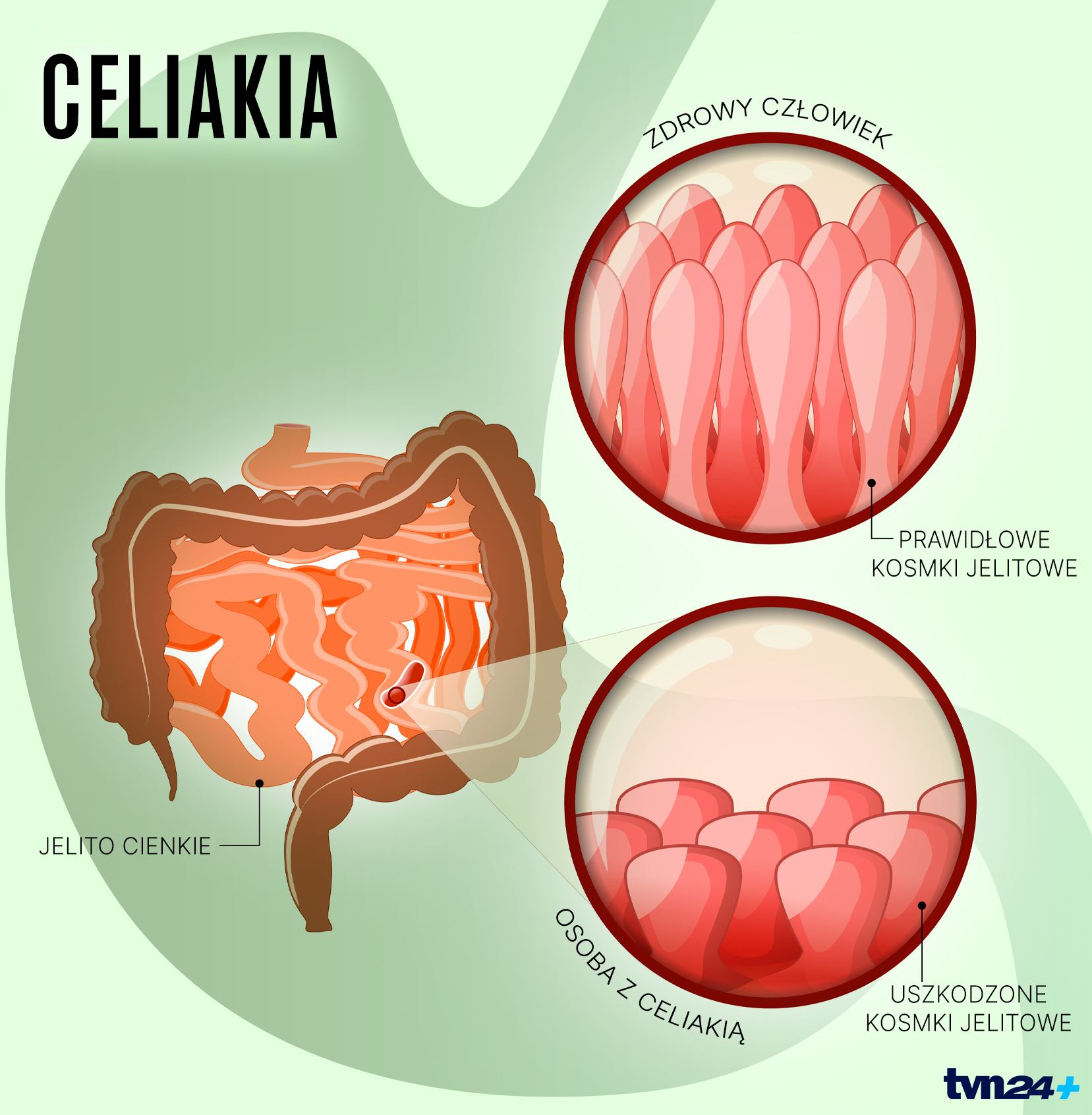 U osób z celiakią kosmki jelitowe ulegają uszkodzeniu