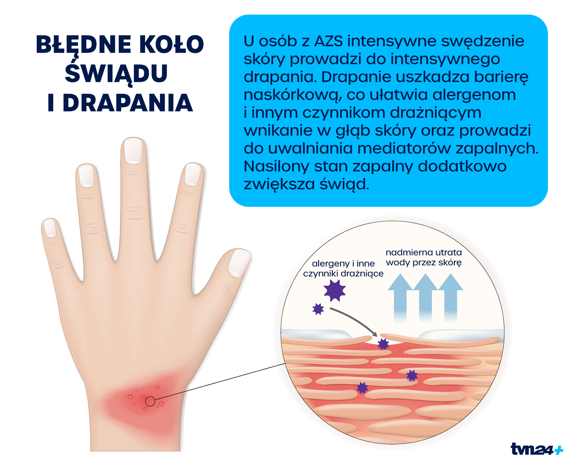 Aktualnie czytasz: To "choroba kameleon". Najgorszy jest świąd