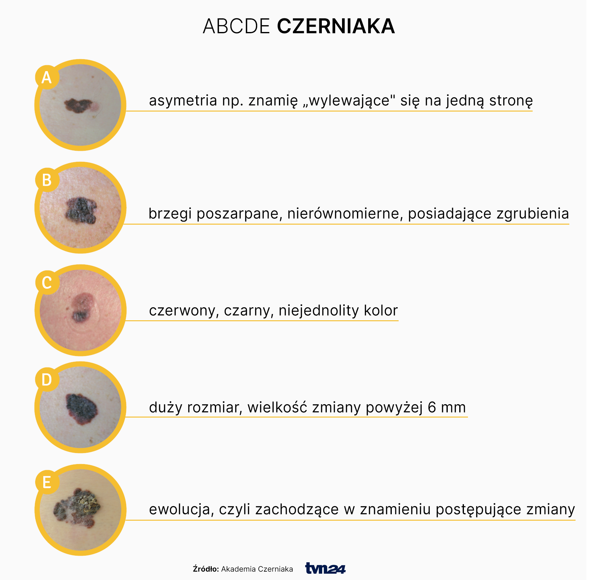ABCDE czerniaka