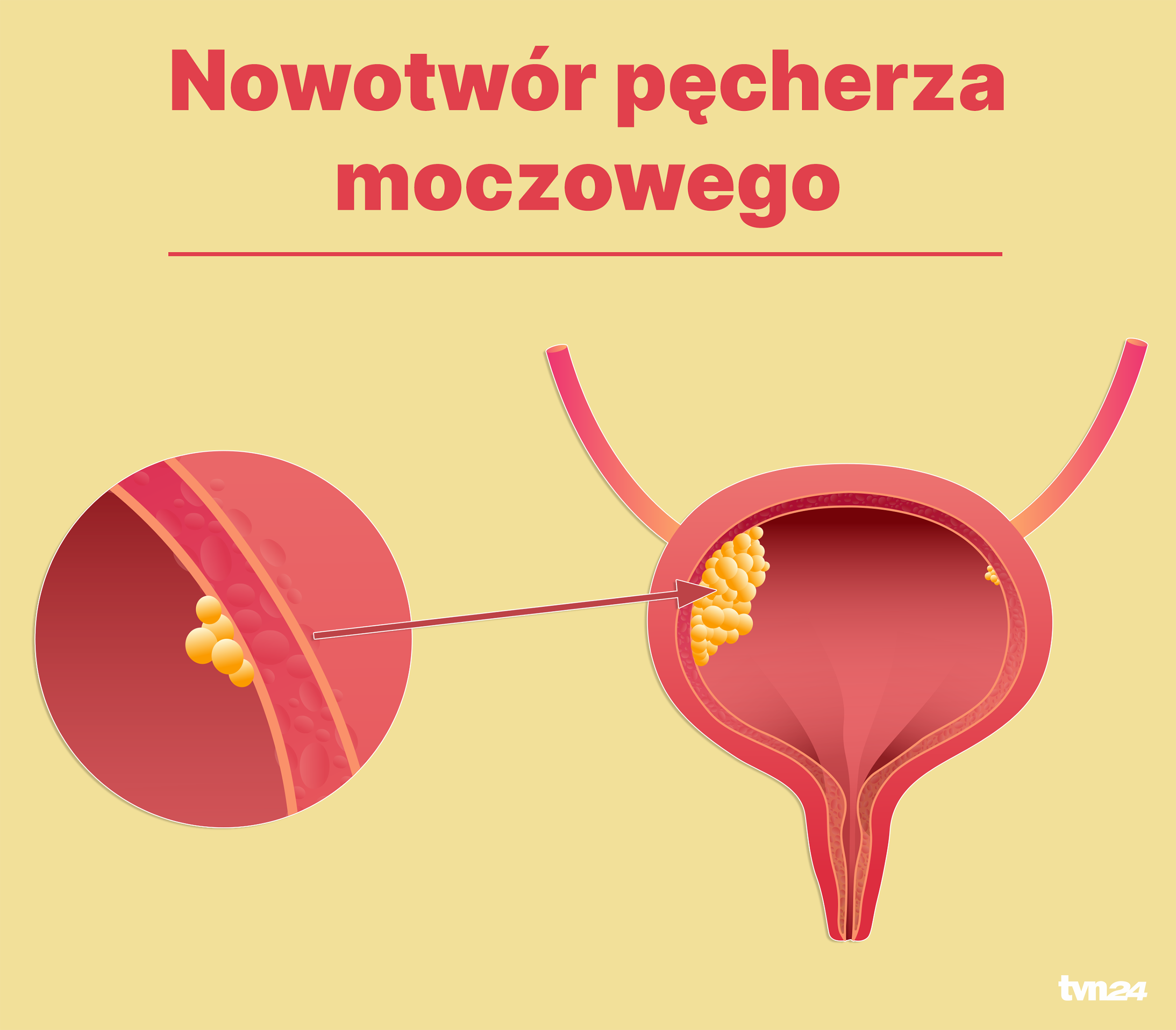 Jak wygląda rak pęcherza moczowego?