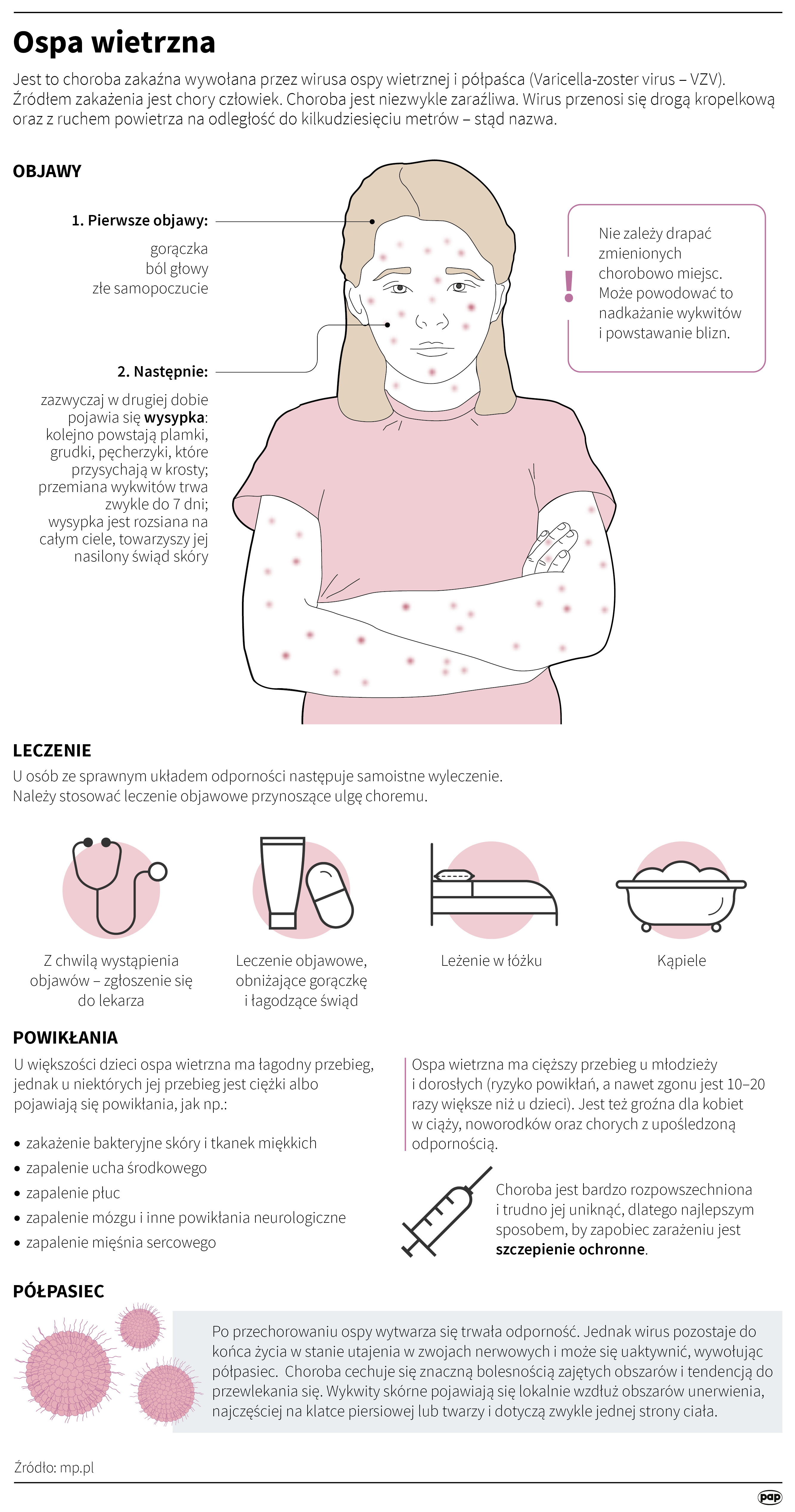 Ospa wietrzna
