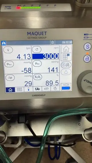 Mężczyzna był podłączony do ECMO