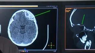 Taki uraz może kosztować życie. Lekarze apelują o zmianę prawa