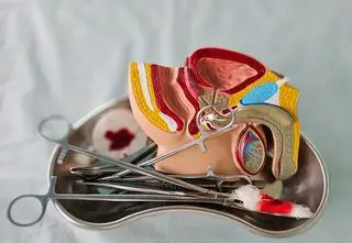 Rak prącia - rzadki, ale groźny. Jak uniknąć amputacji narządu?