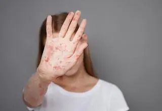 Ta choroba "resetuje" układ odpornościowy. Potwierdzone zakażenia na Podkarpaciu