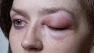 Według danych Polskiego Towarzystwa Alergologicznego alergia dotyka już niemal połowy Polaków.