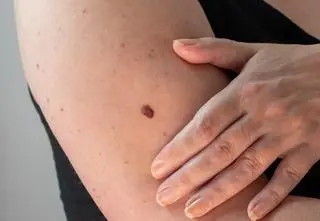 "Przy czerniakach ma to szczególnie duże znaczenie"