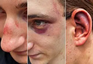 Stłuczenia, krwiaki, obrzęki, niedosłuch. Dwóch nastolatków twierdzi, że pobili ich policjanci 