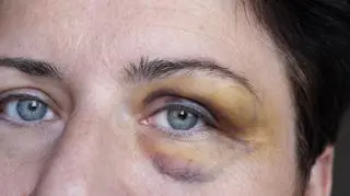 Co roku w Polsce z powodu przemocy ginie około pół tysiąca Polek - alarmuje Centrum Praw Kobiet 