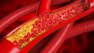 Badania, leki, a może sama dieta? Eksperci wskazują jak walczyć z cichym zabójcą