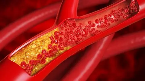 cholesterol shutterstock_2616402807