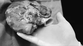 "Transplantacja serca musi stać się rutynowym zabiegiem, mówił prof. Religa i stała się"