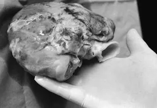 "Transplantacja serca musi stać się rutynowym zabiegiem, mówił prof. Religa i stała się"