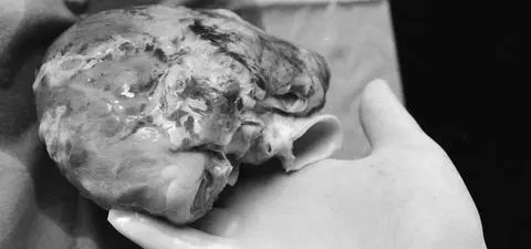 "Transplantacja serca musi stać się rutynowym zabiegiem, mówił prof. Religa i stała się"