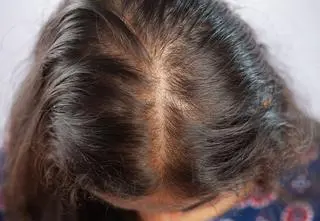 Co na menopauzalne wypadanie włosów? Nie szampony, suplementy i witaminowe koktajle