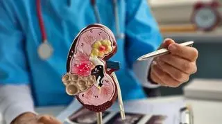 Kamienie nerkowe pełne bakterii. Nowe ustalenia zmieniają wiedzę o chorobie