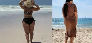 Bywa mylona z otyłością. Wiele kobiet o niej nie wie