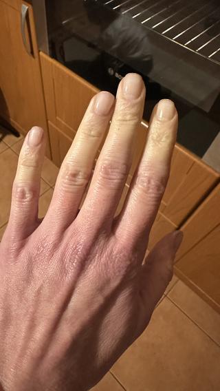 Tak może wyglądać objaw Raynauda