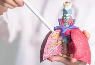 Leczenie raka płuca w Polsce: sukcesy terapii, problemy z diagnostyką