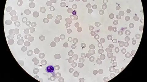 Malaria wciąż jest obecna w wielu krajach świata (wideo archiwalne TVN24 BiS z września 2017 r.)