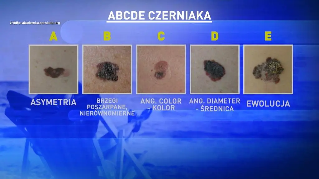 Abecadło czerniaka