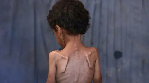 Yazan, dwuletni chłopiec cierpiący na niedożywienie, stoi w zniszczonym domu swojej rodziny w obozie dla uchodźców Al-Shati na zachód od miasta Gaza. 23 lipca 2025 roku