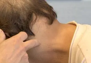 Lekarze usunęli kilka guzów naraz, ablacyjnie