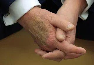 Wielki siniak na dłoni Trumpa wywołuje pytania. Biały Dom zabrał głos