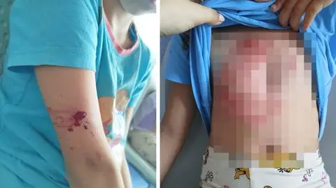 Siedmioletnia Zuzia z poważnymi obrażeniami po ataku psa