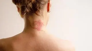 Zaczyna się od plamy na skórze. Może skończyć się chorobą, która zabija