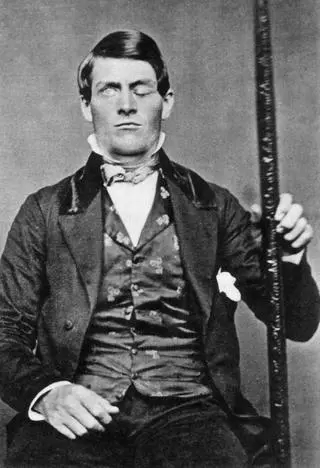 Phineas Gage po wypadku