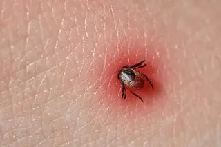 Boreliozą można się zakazić po ukąszeniu kleszcza