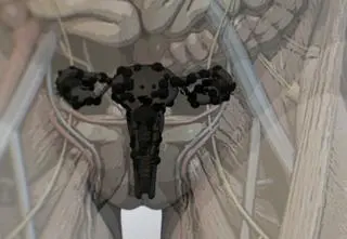 600 chorób powiązanych z endometriozą? Są nowe badania