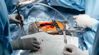 Wyjęli kobiecie wątrobę, usunęli olbrzymi guz i wszczepili ją z powrotem. Wielki sukces polskich lekarzy