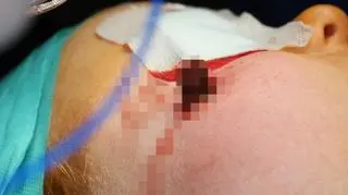 Chłopiec miał fragment drewna przez dwa miesiące w policzku