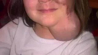 Mała Ala z ekspanderem pod skórą szyi