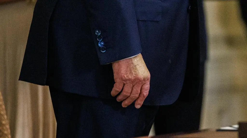 Zamaskowany siniak na dłoni Trumpa