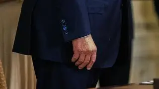 Zamaskowany siniak na dłoni Trumpa