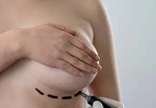 Rekonstrukcja po mastektomii to nie biust jak z Instagrama